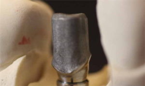 Individueller Implantataufbau Titan