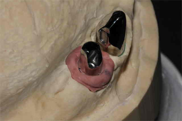 Pfeilervermehrung durch Implantat und Blick auf das Teleklick